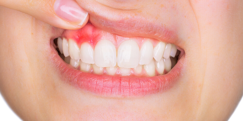 Bleeding Gums Treatment in Sayan